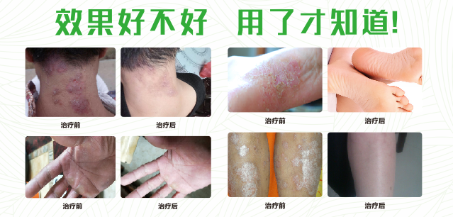 草莓视频在线观看网站免费视频真菌清喷剂